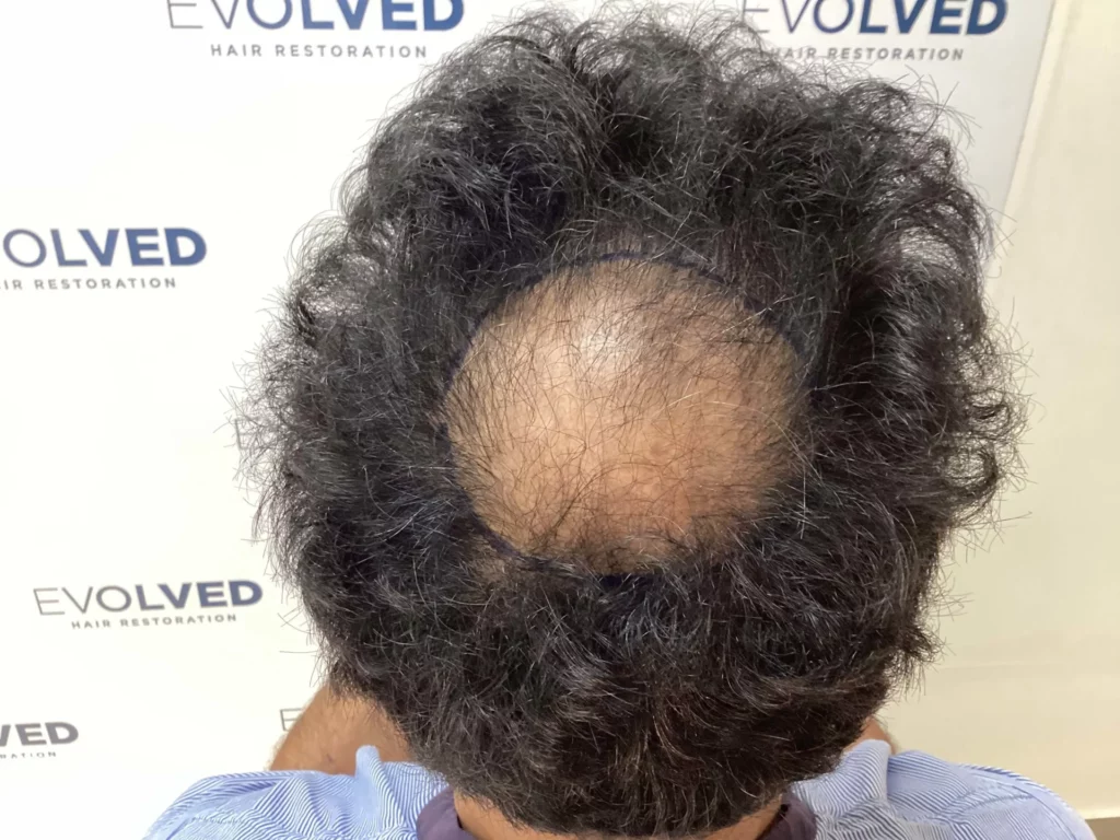 Reference patient two before treatment